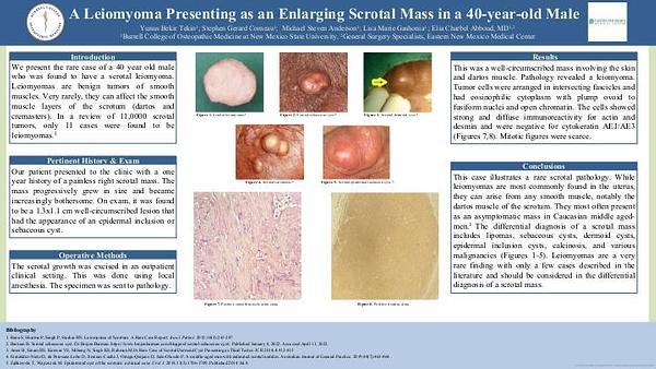 A Leiomyoma Presenting as an Enlarging Scrotal Mass in a 40-year-old Male