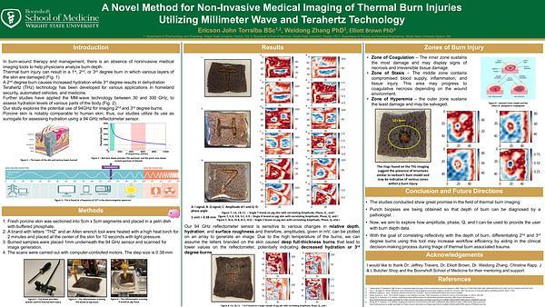 A Novel Method for Non-Invasive Medical Imaging of Thermal Burn Injuries Utilizing Millimeter Wave and Terahertz Technology