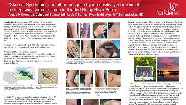 “Skeeter Syndrome” and other mosquito hypersensitivity reactions at a sleepaway summer camp in flooded Rainy River Basin