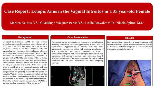 Case Report: Ectopic Anus in the Vaginal Introitus in a 35 year-old Female
