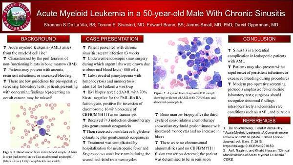 Acute Myeloid Leukemia in a 50-year-old Male With Chronic Sinusitis