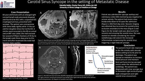 Carotid sinus syncope in the setting of metastatic disease
