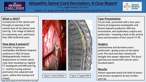 Idiopathic Spinal Cord Herniation: A Case Report