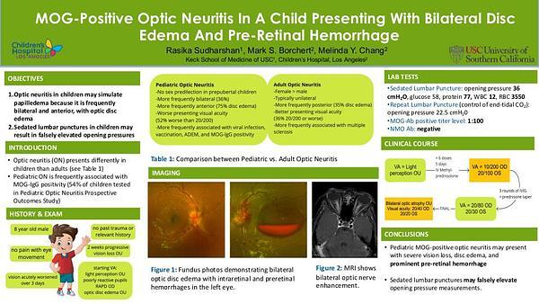 MOG-Positive Optic Neuritis In A Child Presenting With Bilateral Disc Edema And Pre-Retinal Hemorrhage