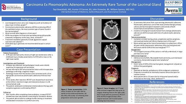 Carcinoma Ex Pleomorphic Adenoma: An Extremely Rare Tumor of the Lacrimal Gland