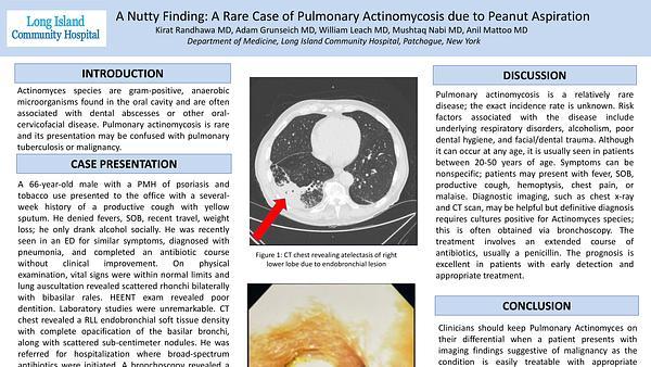 A Nutty Finding: A Rare Case of Pulmonary Actinomycosis due to Peanut Aspiration
