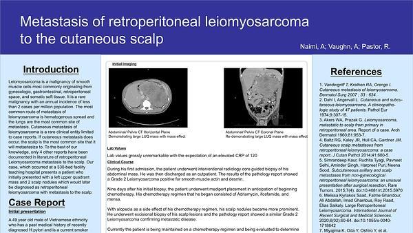 Metastasis of retroperitoneal leiomyosarcoma to the cutaneous scalp