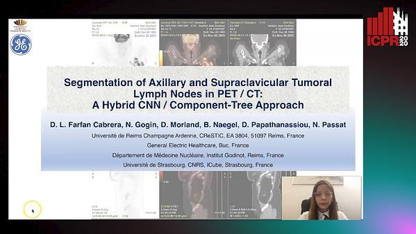 Segmentation of Axillary and Supraclavicular Tumoral Lymph Nodes in PET/CT: A Hybrid CNN/Component-Tree Approach