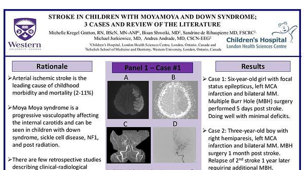 Stroke in children with moyamoya and down syndrome; 3 cases and review of the literature