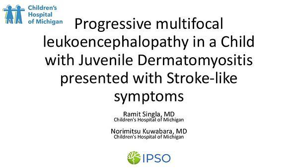Progressive multifocal leukoencephalopathy in a child with juvenile dermatomyositis presented as stroke