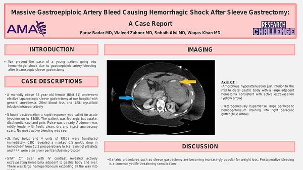Massive Gastroepiploic Artery Bleed Causing Hemorrhagic Shock After Sleeve Gastrectomy: A Case Report