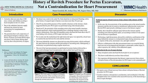 History of Ravitch Procedure for Pectus Excavatum, Not a Contraindication for Heart Procurement