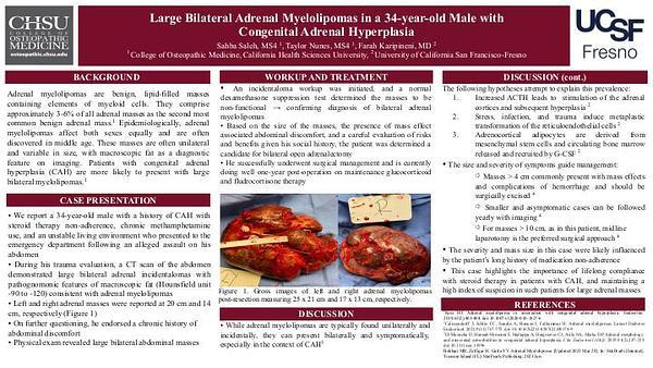 Large Bilateral Adrenal Myelolipomas in a 34-year old Male with Congenital Adrenal Hyperplasia