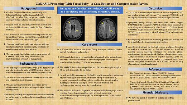 CADASIL Presenting With Facial Palsy –A Case Report and Comprehensive Review