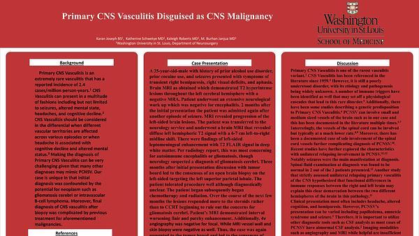 Primary CNS Vasculitis Disguised as CNS Malignancy 
