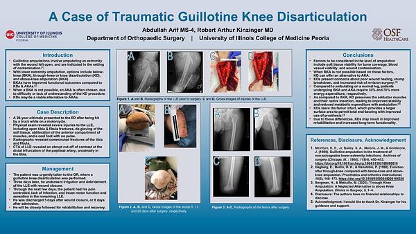 A Case of Traumatic Guillotine Knee Disarticulation