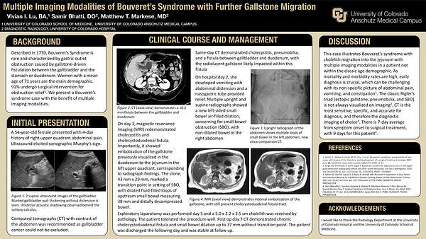 Multiple Imaging Modalities of Bouveret's Syndrome with Further Gallstone Migration