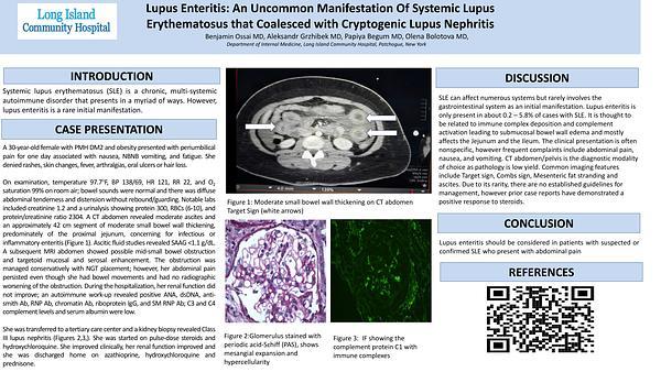 

Lupus Enteritis: An Uncommon Manifestation of Systemic Lupus Erythematosus that Coalesced with Cryptogenic Lupus Nephritis