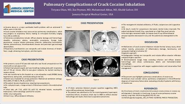 Pulmonary Complications of Crack Cocaine Inhalation